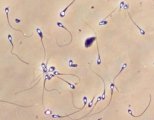 Агрегация сперматозоидов причины и лечение