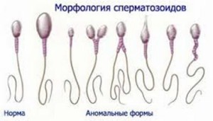 Неправильная морфология сперматозоидов